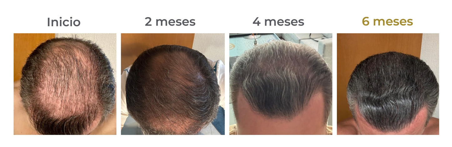Shampoo Mandarina -Previene la caída del cabello